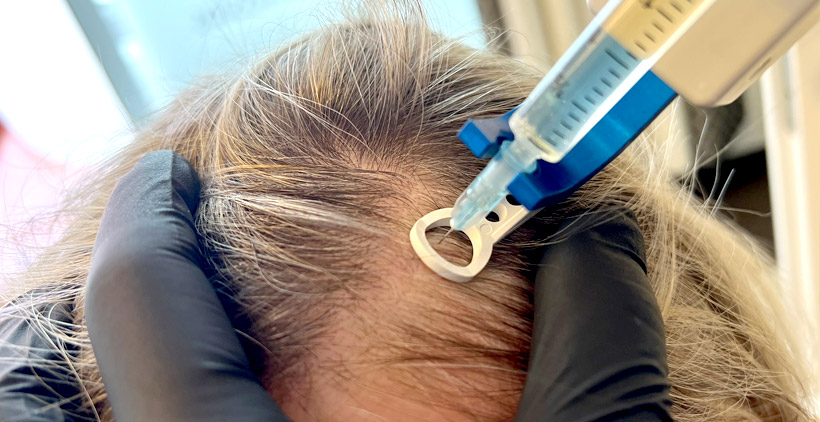 Nahaufnahme einer Mesotherapie-Behandlung gegen Haarausfall, bei der Wirkstoffe direkt in die Kopfhaut injiziert werden, um das Haarwachstum zu fördern.